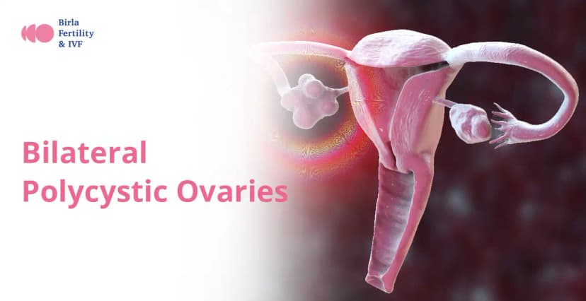 Bilateral PCOS &#8211; Symptoms, Causes, Complications &#038; Treatment