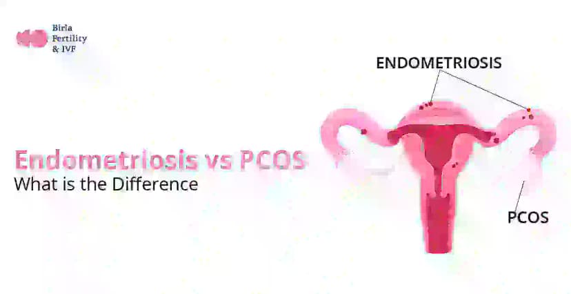 এন্ডোমেট্রিওসিস বনাম PCOS: পার্থক্য কি?