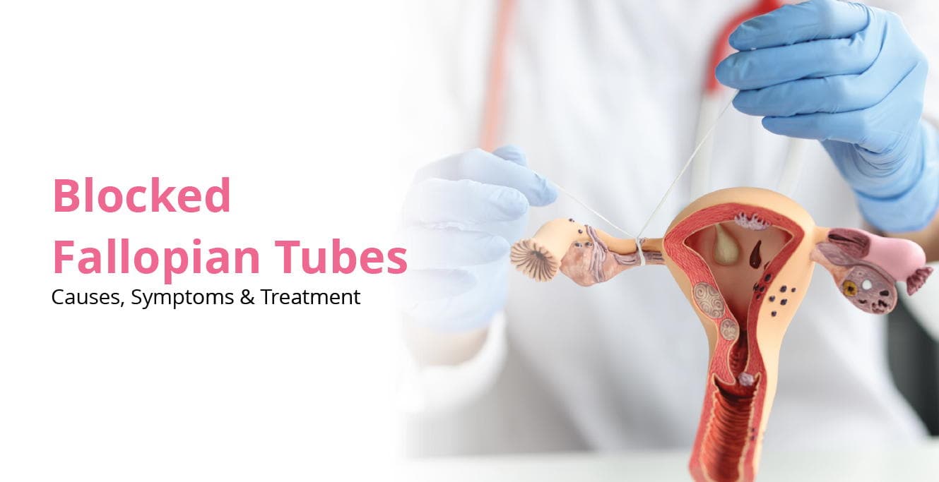 Blocked Fallopian Tube – Causes, Symptoms and Treatment