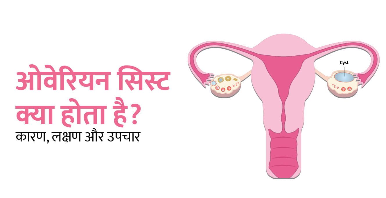 Ovarian Cyst Meaning in Hindi: ओवेरियन सिस्ट क्या होता है? लक्षण और उपचार