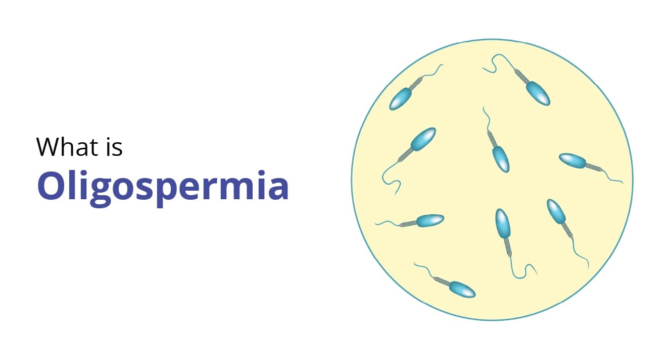Oligospermia(Low Sperm Count): Symptoms & Cure
