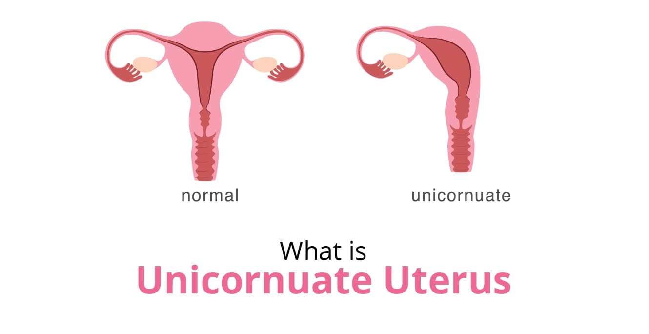 Unicornuate Uterus: How It Affects Fertility & Pregnancy