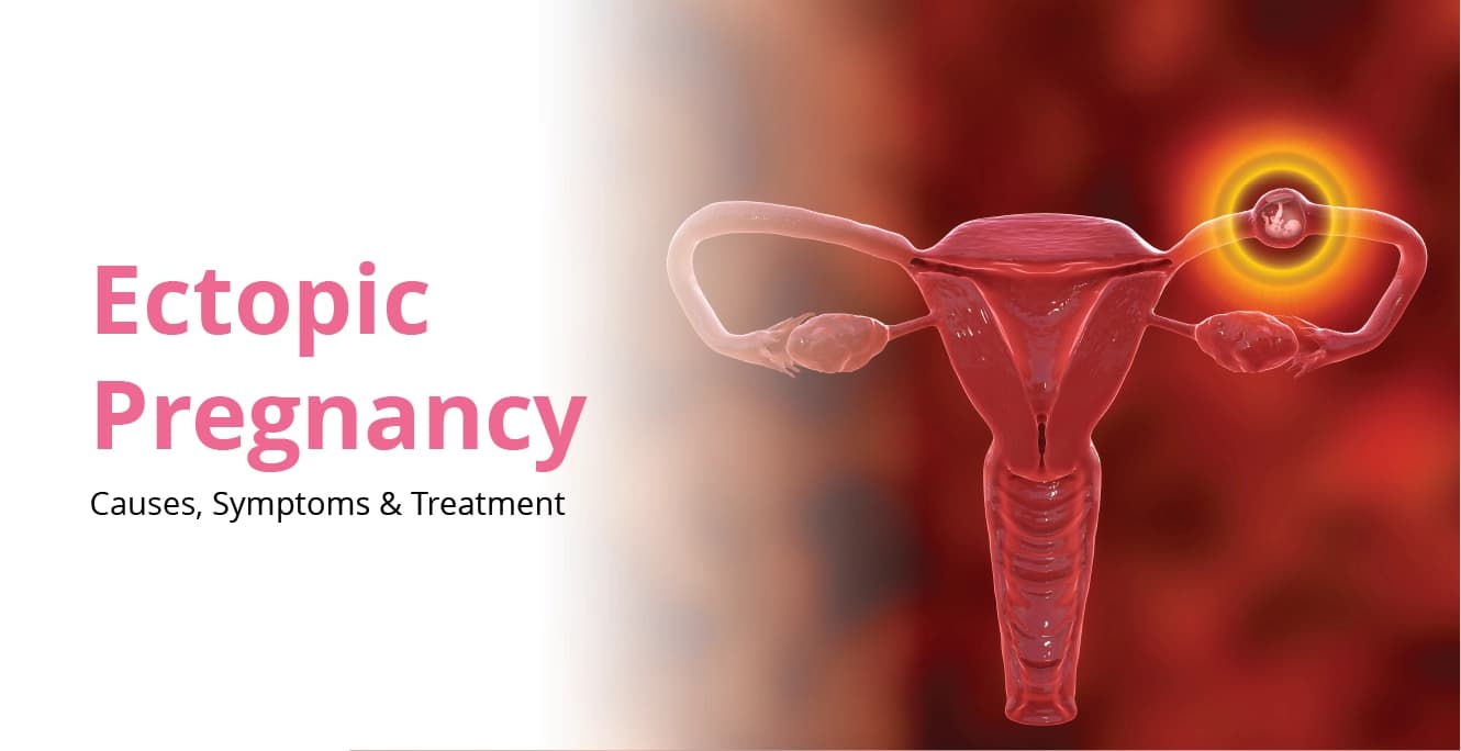 Ectopic Pregnancy: Causes, Symptoms, Types & Treatment