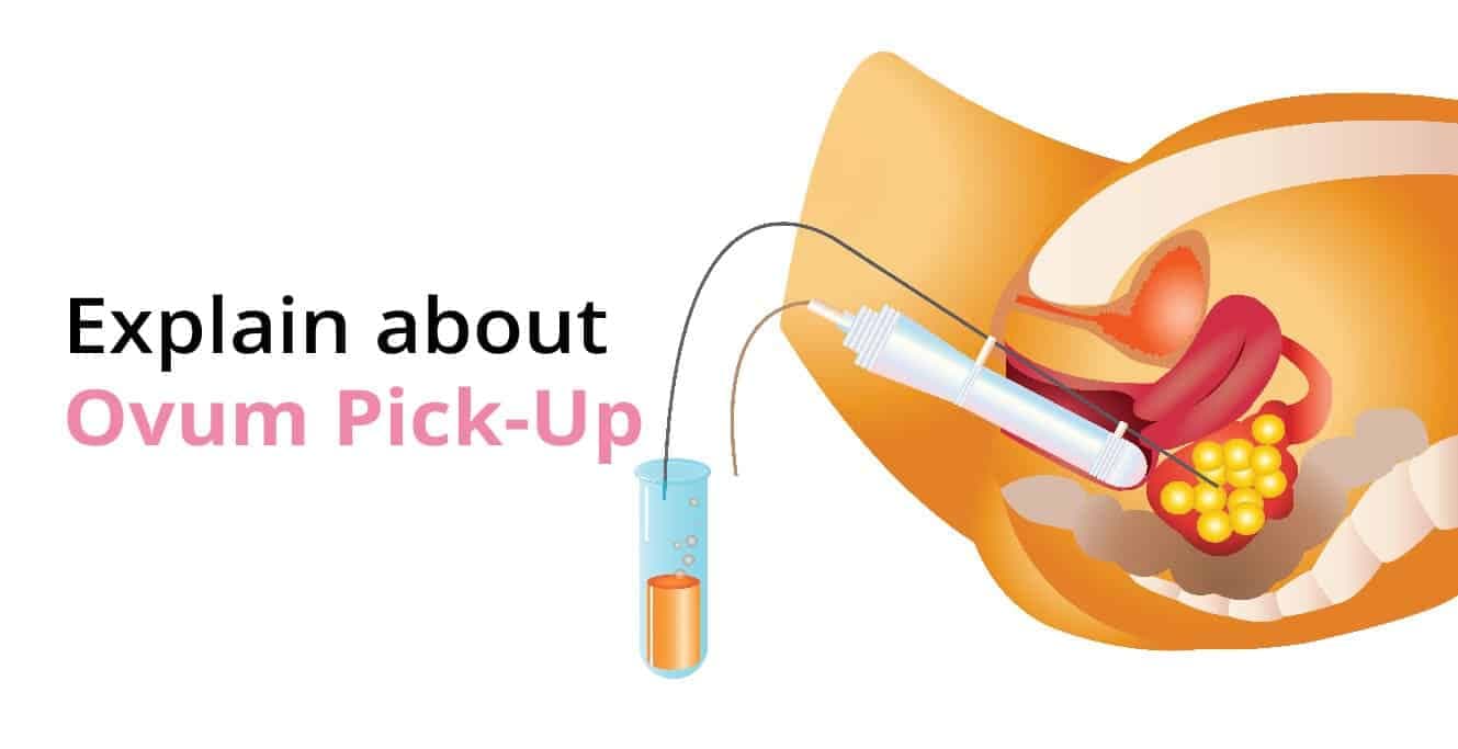 Ovum Pick-Up: Safe Egg Retrieval Procedure