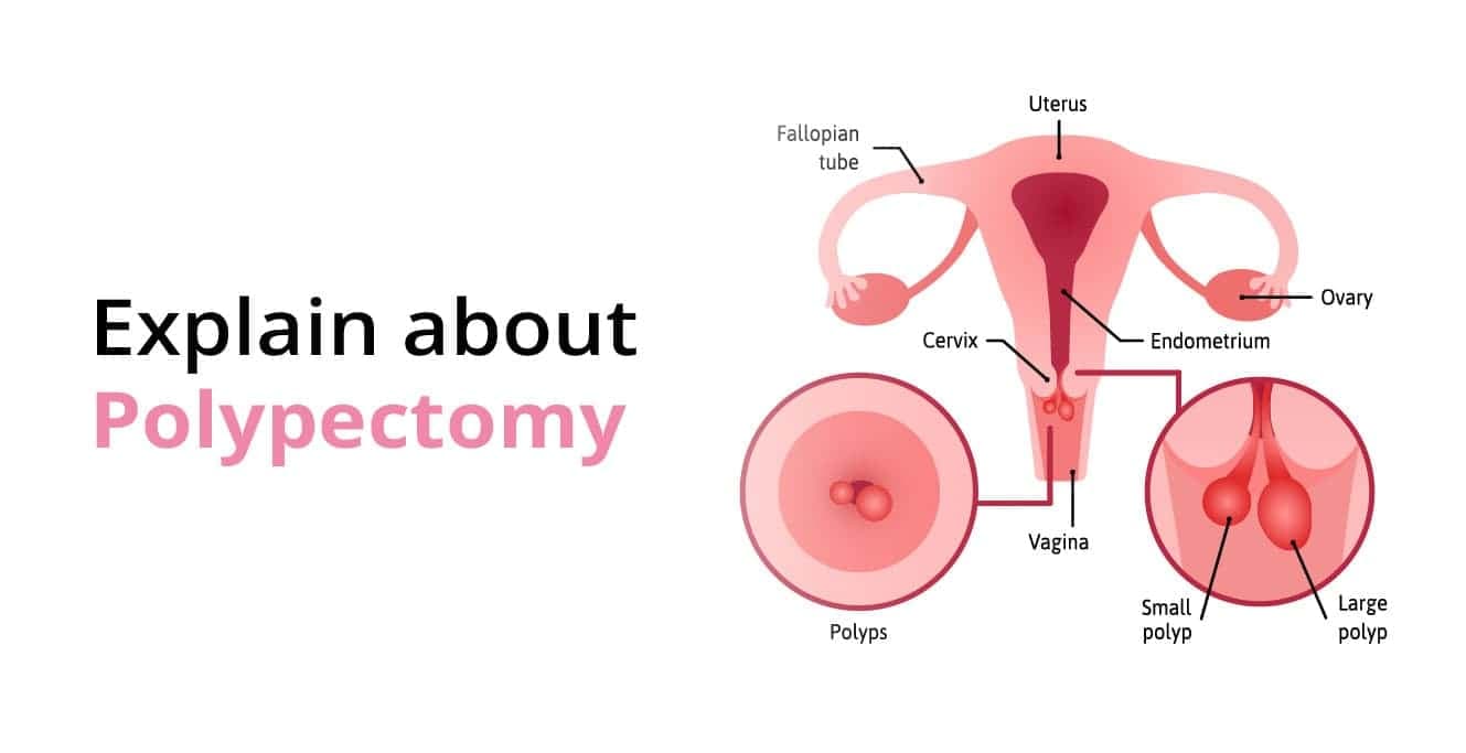 પોલીપેક્ટોમી: પોલીપના લક્ષણો, નિદાન અને સારવાર