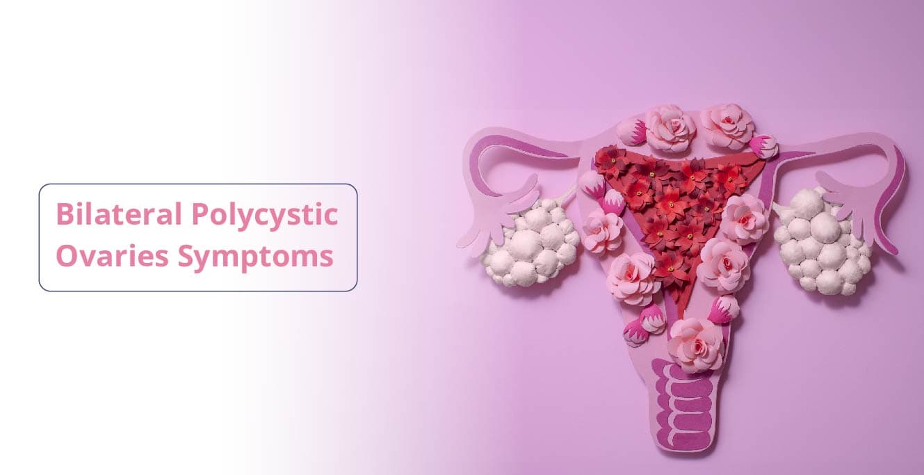 દ્વિપક્ષીય PCOS: કારણો, લક્ષણો અને સારવાર