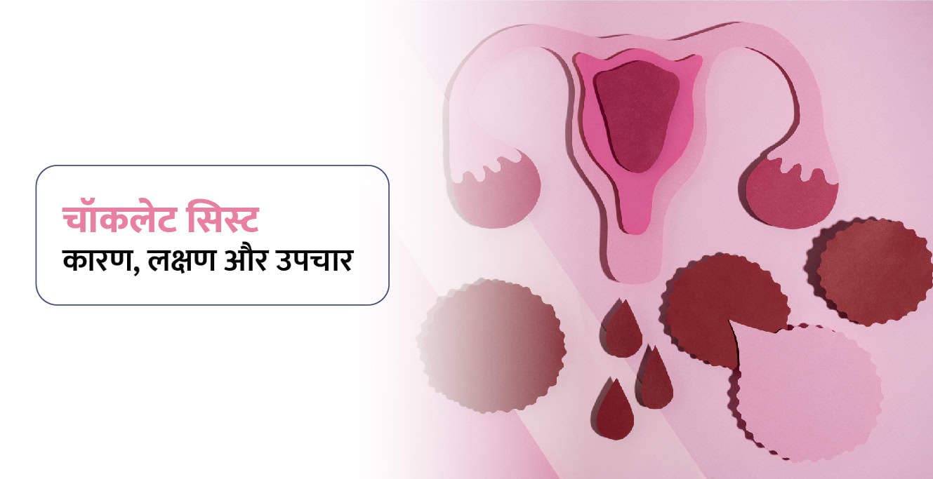 Chocolate Cyst Meaning in Hindi – चॉकलेट सिस्ट क्या है? कारण, लक्षण और उपचार
