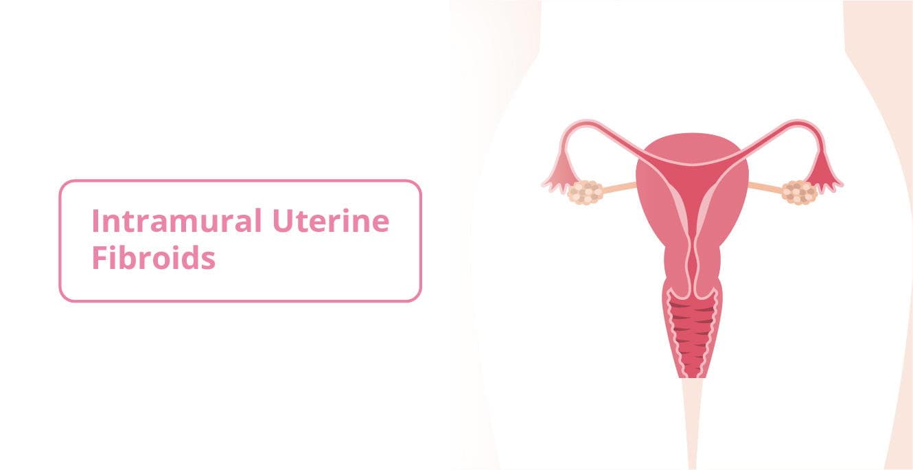 Intramural Uterine Fibroids: Causes, Symptoms and Treatment