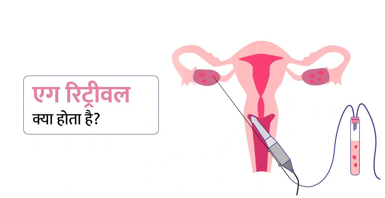 एग रिट्रीवल क्या होता है? (Egg Retrieval In Hindi)