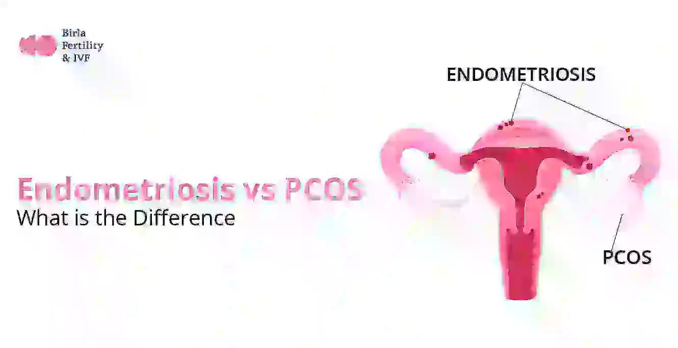 എൻഡോമെട്രിയോസിസ് vs PCOS: എന്താണ് വ്യത്യാസം