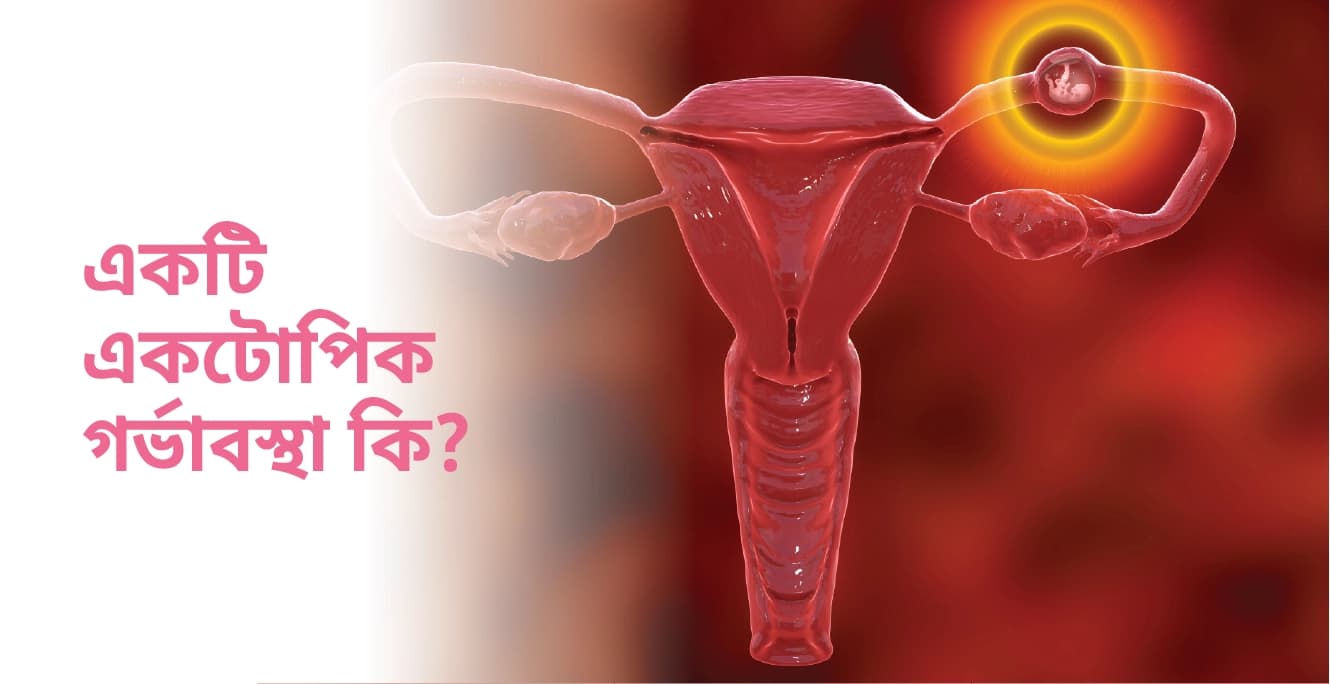 একটি একটোপিক গর্ভাবস্থা কি?