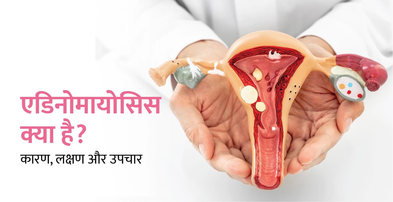 एडिनोमायोसिस क्या है? कारण, लक्षण, निदान और उपचार