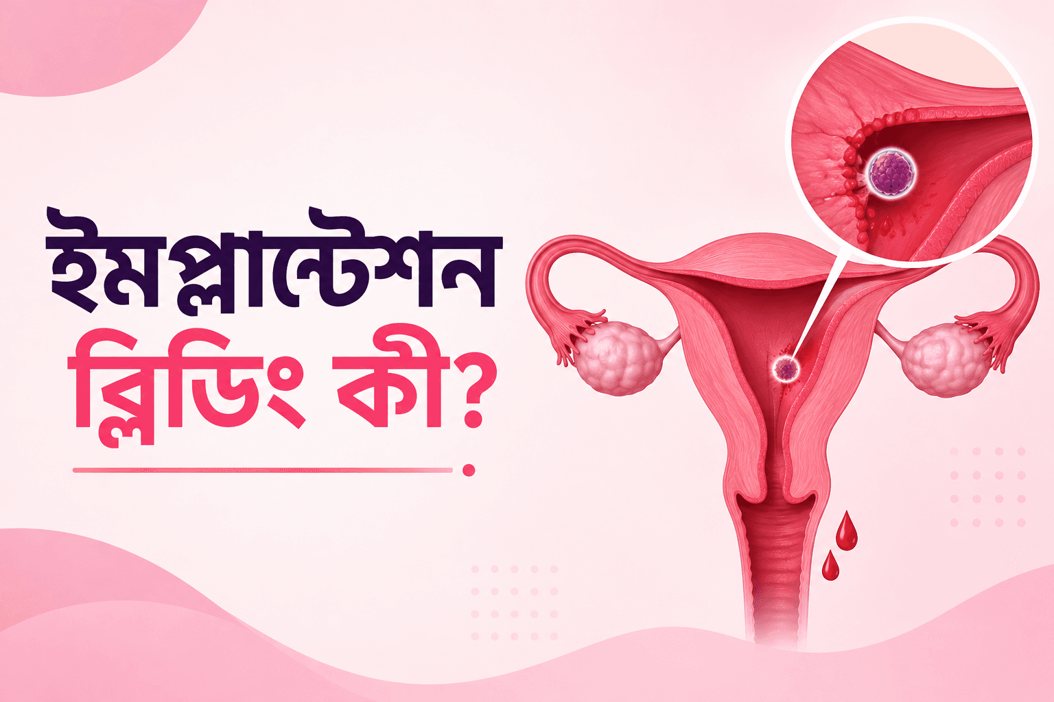 ইমপ্লান্টেশন রক্তপাত সম্পর্কে আপনার যা জানা দরকার