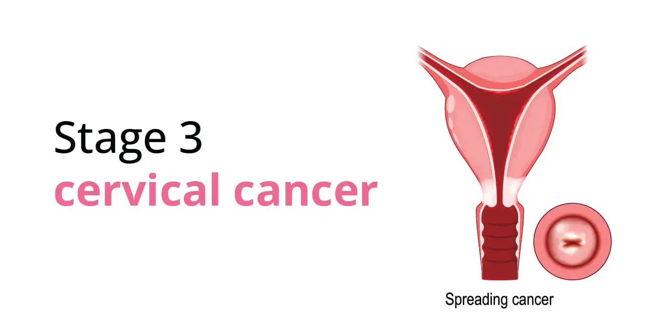 Stage 3 Cervical Cancer: Symptoms, Diagnosis, and Treatment