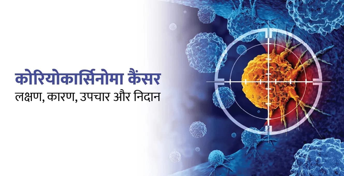 कोरियोकार्सिनोमा कैंसर: लक्षण, कारण, उपचार और निदान