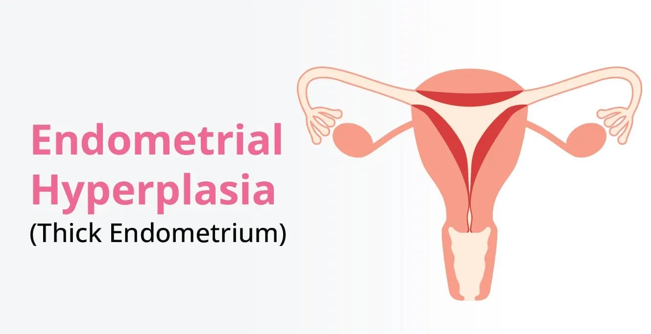 Endometrial Hyperplasia: Causes, Symptoms & Treatment
