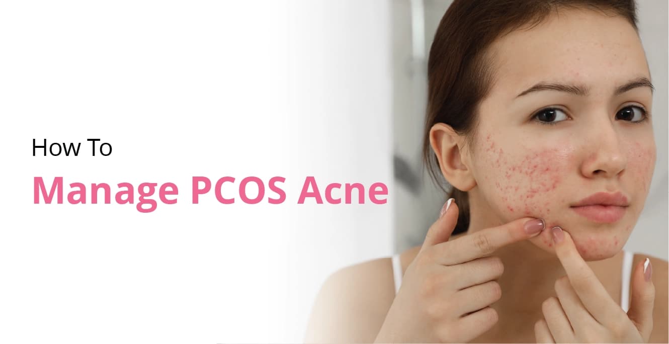 How To Manage PCOS Acne