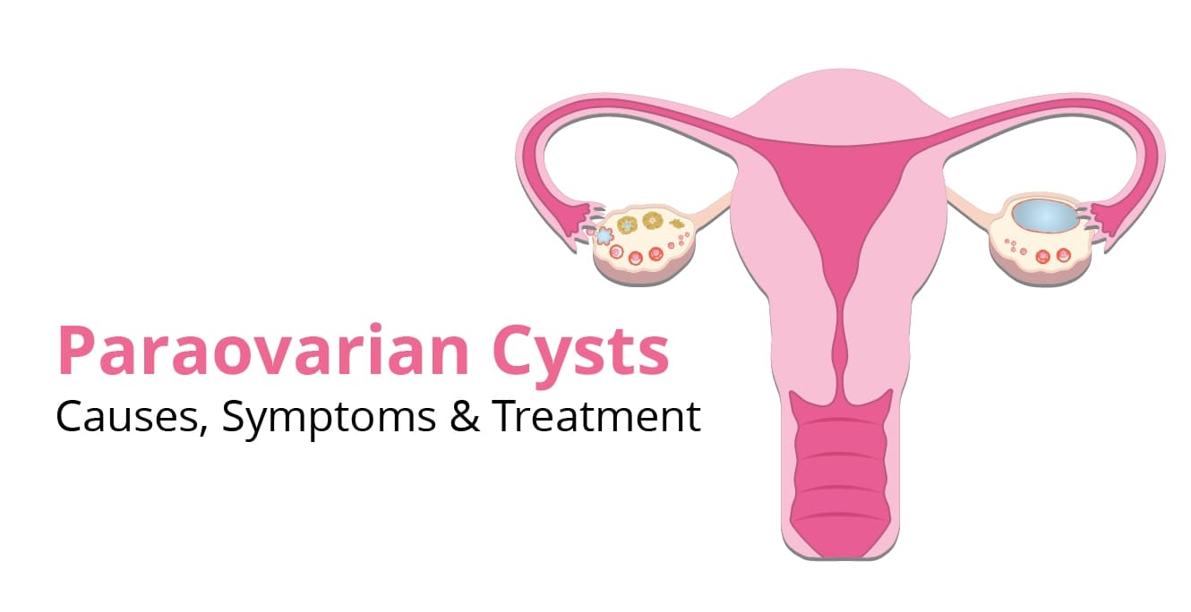 Paraovarian Cysts: Causes, Symptoms & Treatment