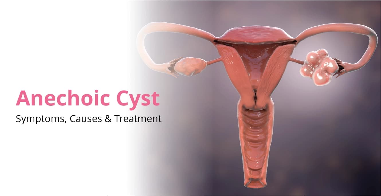 Anechoic Cyst: Symptoms, Causes & Treatment