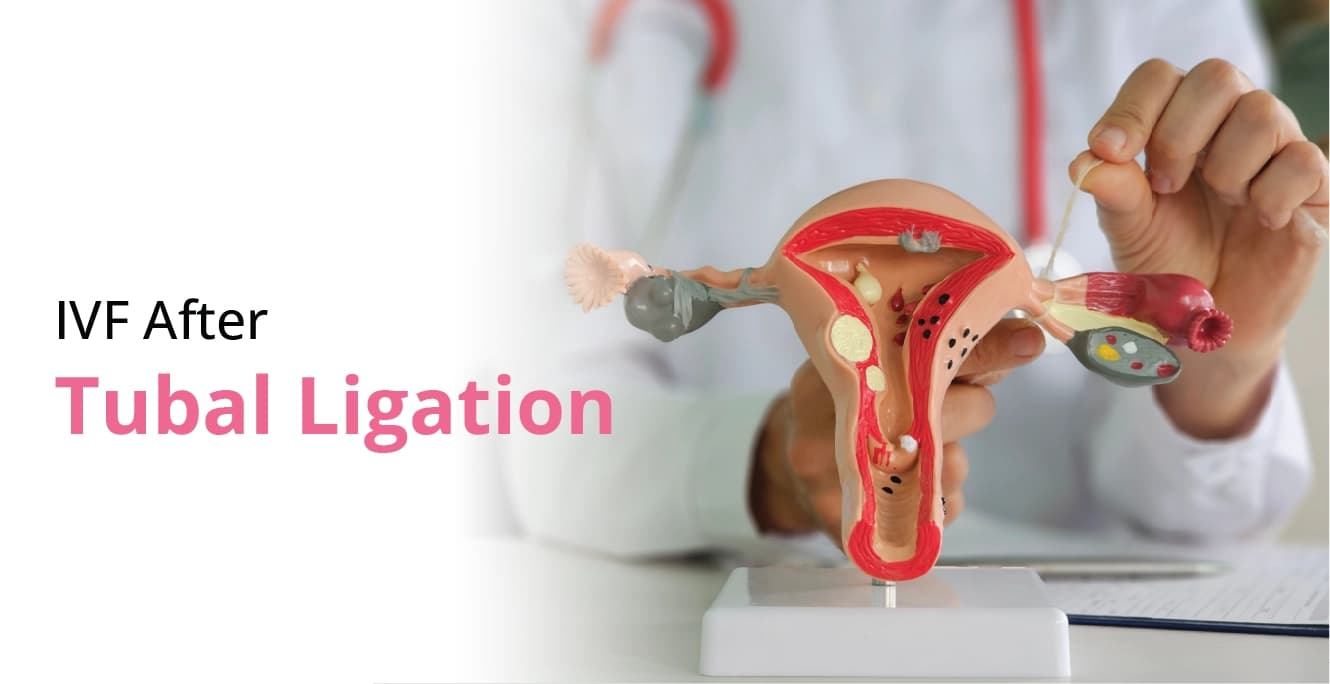 IVF After Tubal Ligation