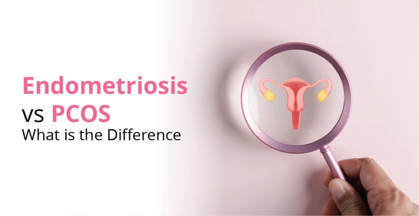 Endometriosis vs PCOS: What is the Difference