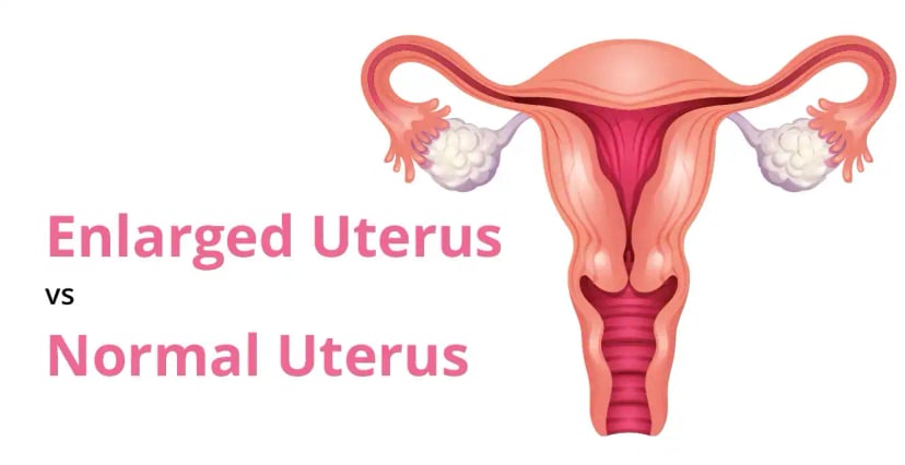 Enlarged Uterus (Adenomyosis) Vs. Normal Uterus