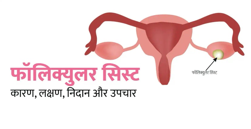 फॉलिक्युलर सिस्ट क्या है? कारण, लक्षण, निदान और उपचार