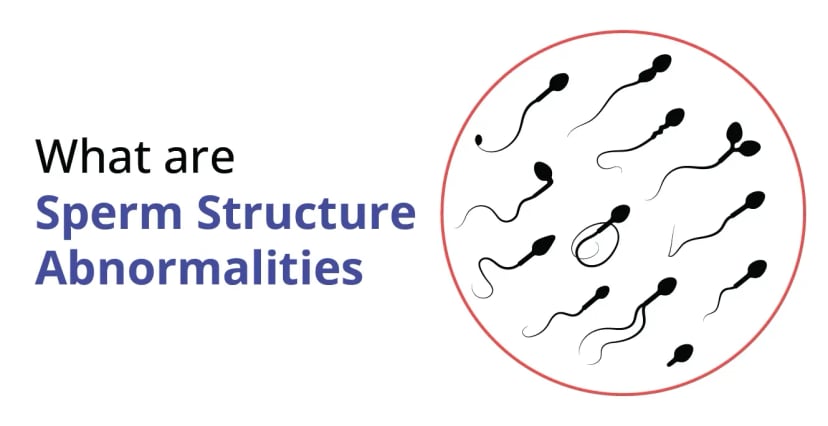 Sperm Abnormalities: Types, Causes & Treatment