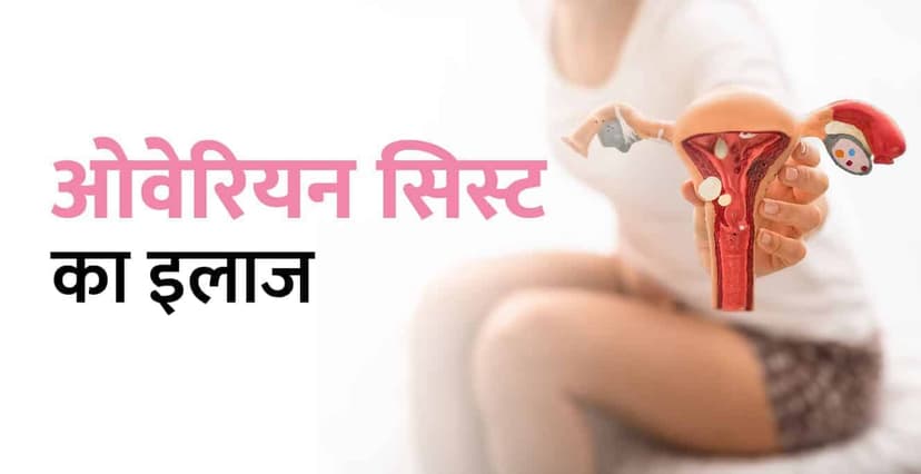 ओवेरियन सिस्ट काय आहे – कारण, लक्षण आणि उपचार