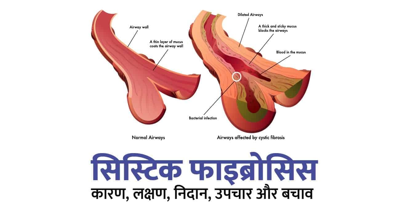सिस्टिक फाइब्रोसिस के कारण, लक्षण, उपचार और बचाव – Cystic Fibrosis in Hindi