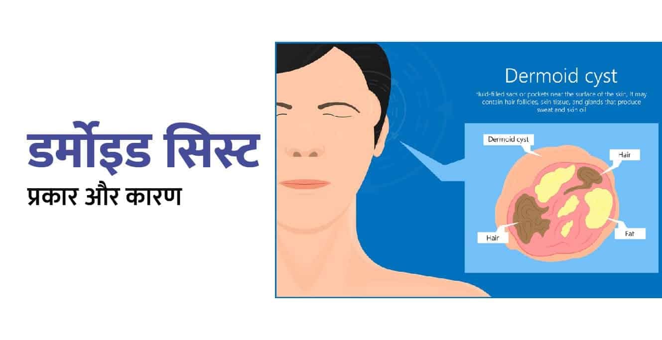Dermoid Cyst in Hindi: डर्मोइड सिस्ट क्या है? प्रकार और कारण
