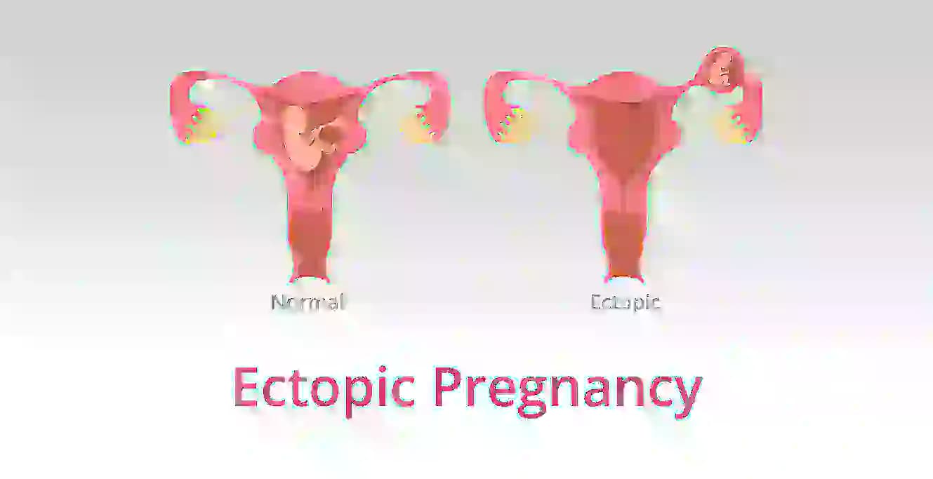 Ectopic Pregnancy: Causes, Symptoms, Types & Treatment