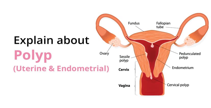 Uterine Polyps: Causes, Symptoms, Diagnosis, and Treatment