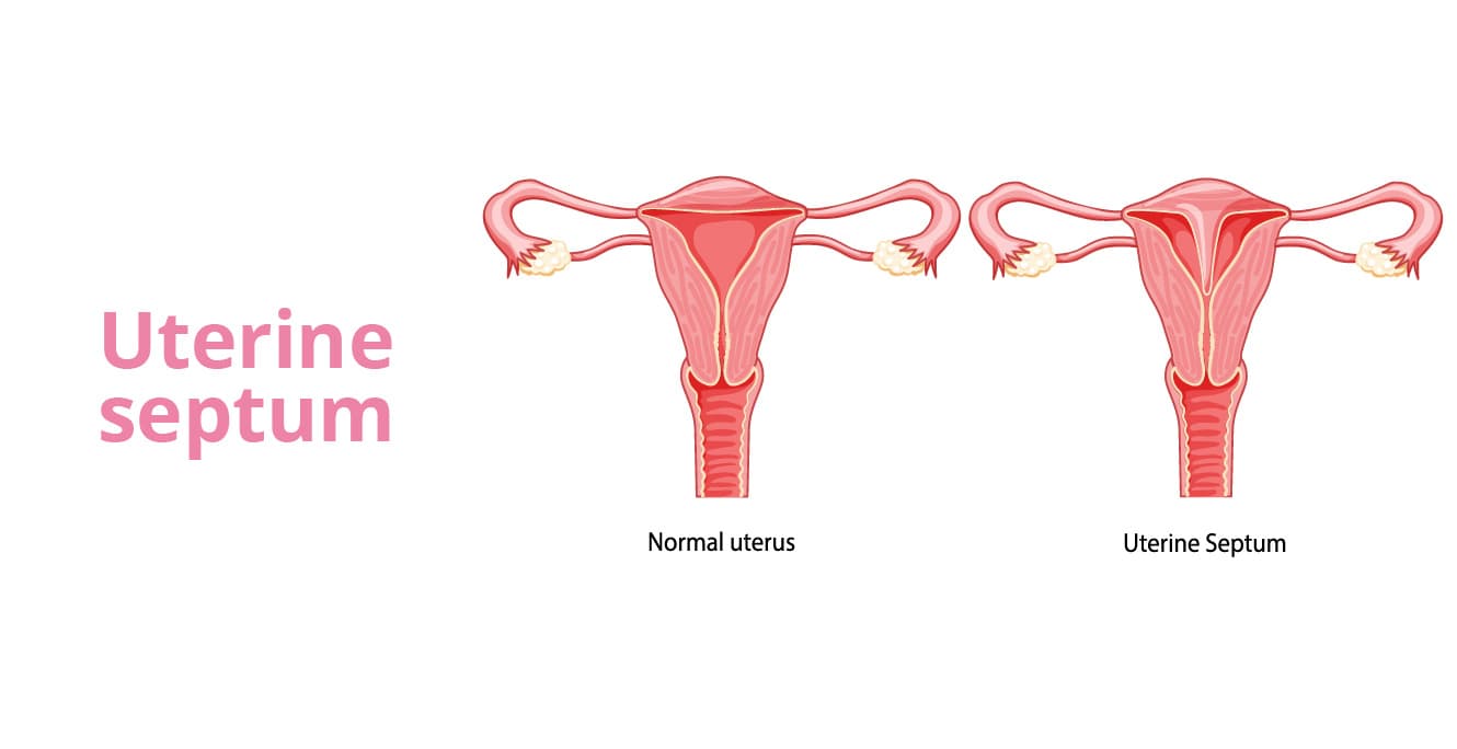 Uterine Septum: Symptoms, Causes, and Treatment