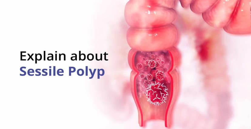 सेसाइल पॉलीपची लक्षणे, निदान आणि त्याचे उपचार
