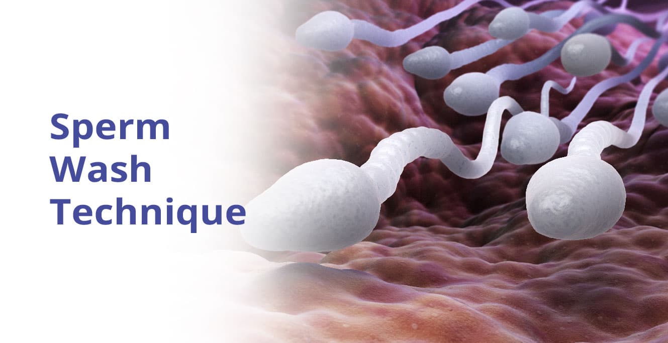 స్పెర్మ్ వాష్ టెక్నిక్