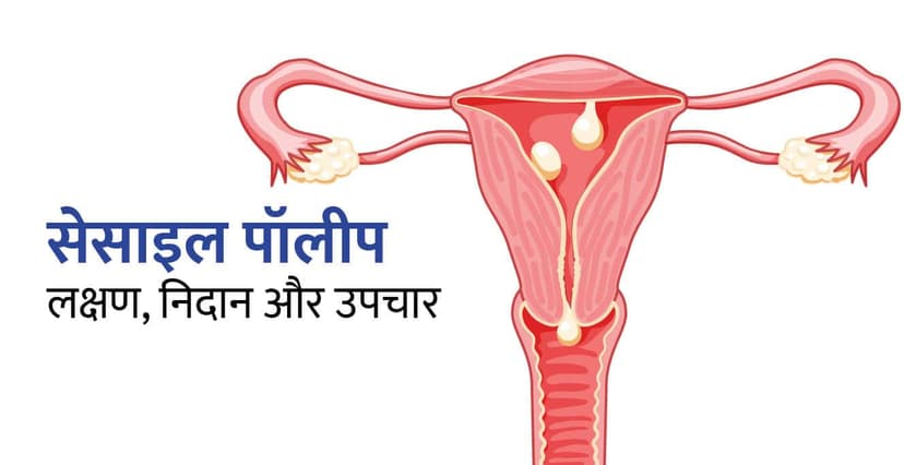 सेसाइल पॉलीप: लक्षण, प्रकार, निदान और उपचार