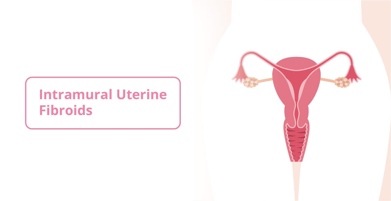 Intramural Uterine Fibroids: Causes, Symptoms and Treatment