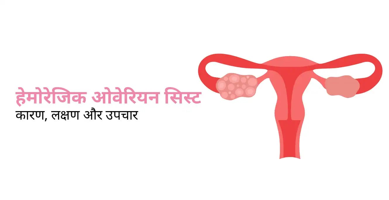 Hemorrhagic Cyst in Hindi – हेमोरेजिक ओवेरियन सिस्ट के लक्षण और उपचार