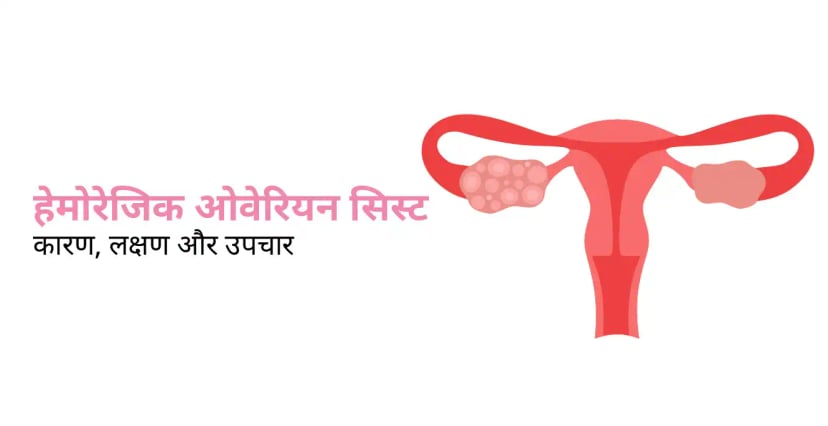 Hemorrhagic Cyst in Hindi – हेमोरेजिक ओवेरियन सिस्ट के लक्षण और उपचार