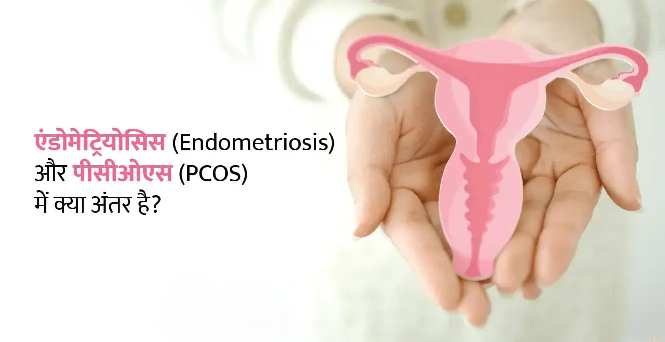 एंडोमेट्रियोसिस (Endometriosis) और पीसीओएस (PCOS) में क्या अंतर है?