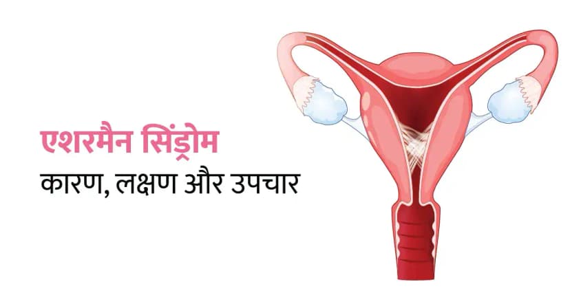 Asherman Syndrome in Hindi – एशरमैन सिंड्रोम क्या है? कारण, लक्षण और उपचार
