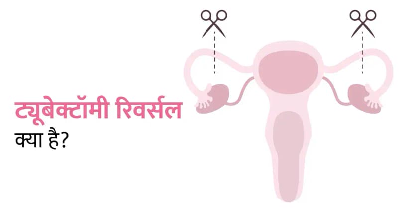 ट्यूबेक्टॉमी रिवर्सल क्या है?