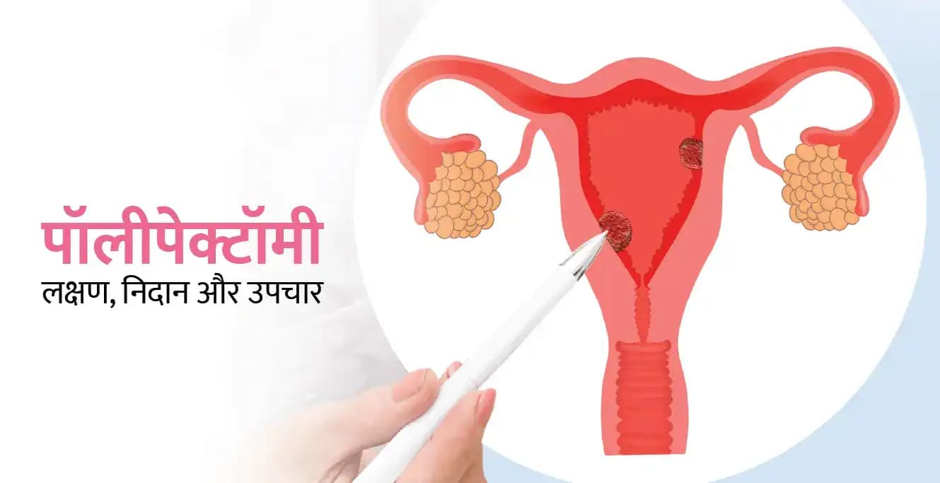 पॉलीपेक्टॉमी: पॉलीप के लक्षण, निदान और उपचार