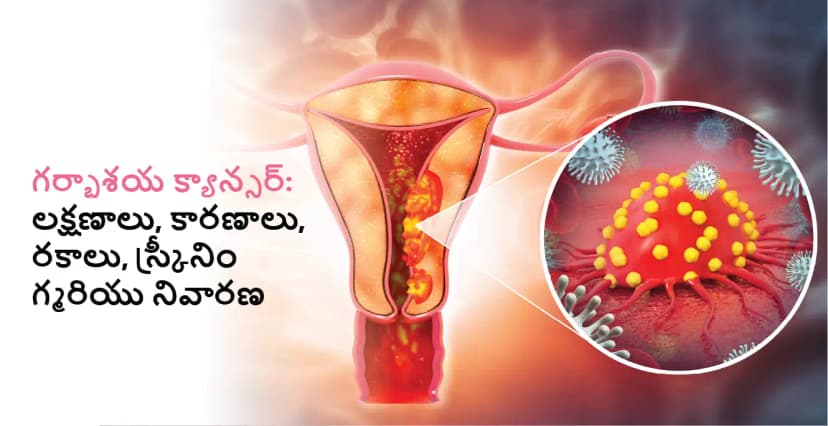 సర్వైకల్ క్యాన్సర్: లక్షణాలు, కారణం, రకం, స్క్రీనింగ్ మరియు నివారణ