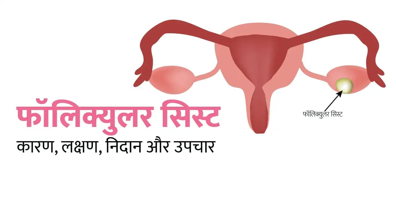 फॉलिक्युलर सिस्ट क्या है? कारण, लक्षण, निदान और उपचार