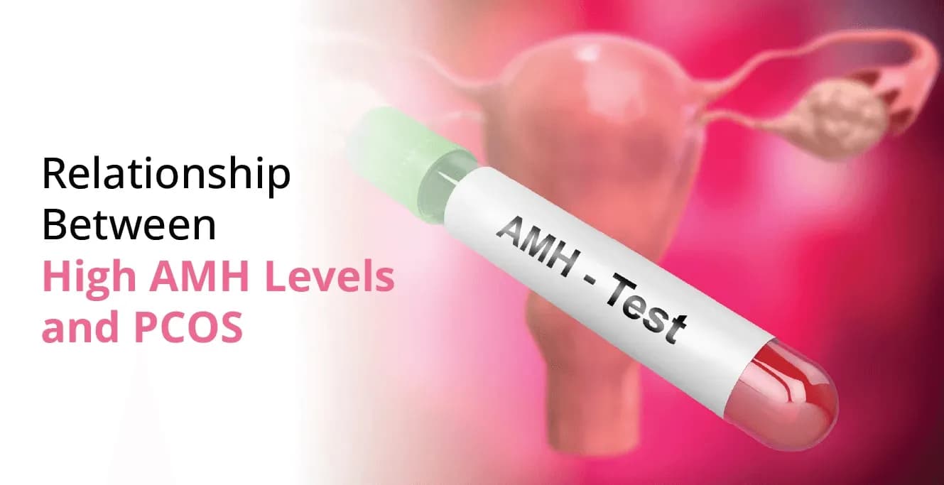 Relationship Between High AMH Levels and PCOS