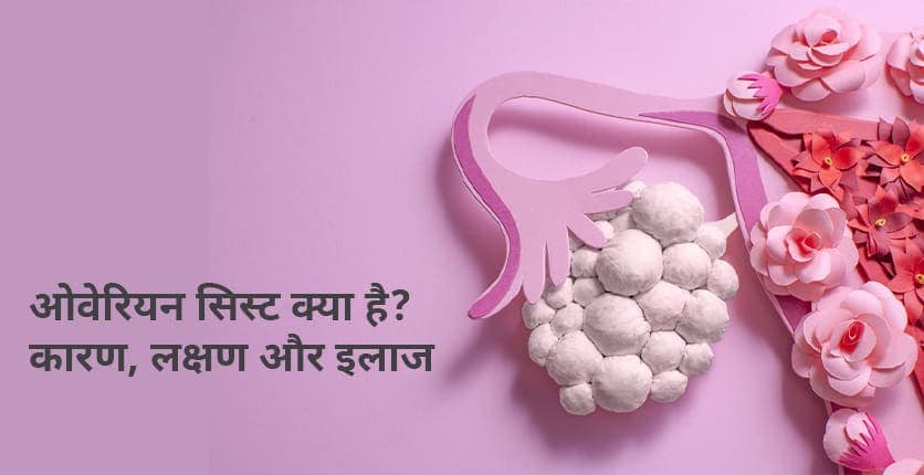 Ovarian Cyst Meaning in Hindi: ओवेरियन सिस्ट क्या होता है? लक्षण और उपचार