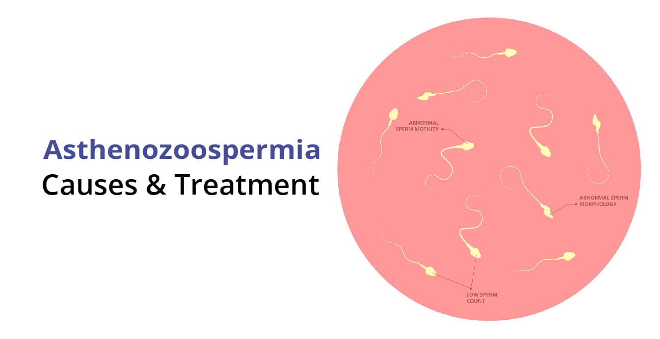 Asthenozoospermia কি: পর্যায়, কারণ, পরীক্ষা এবং চিকিত্সা