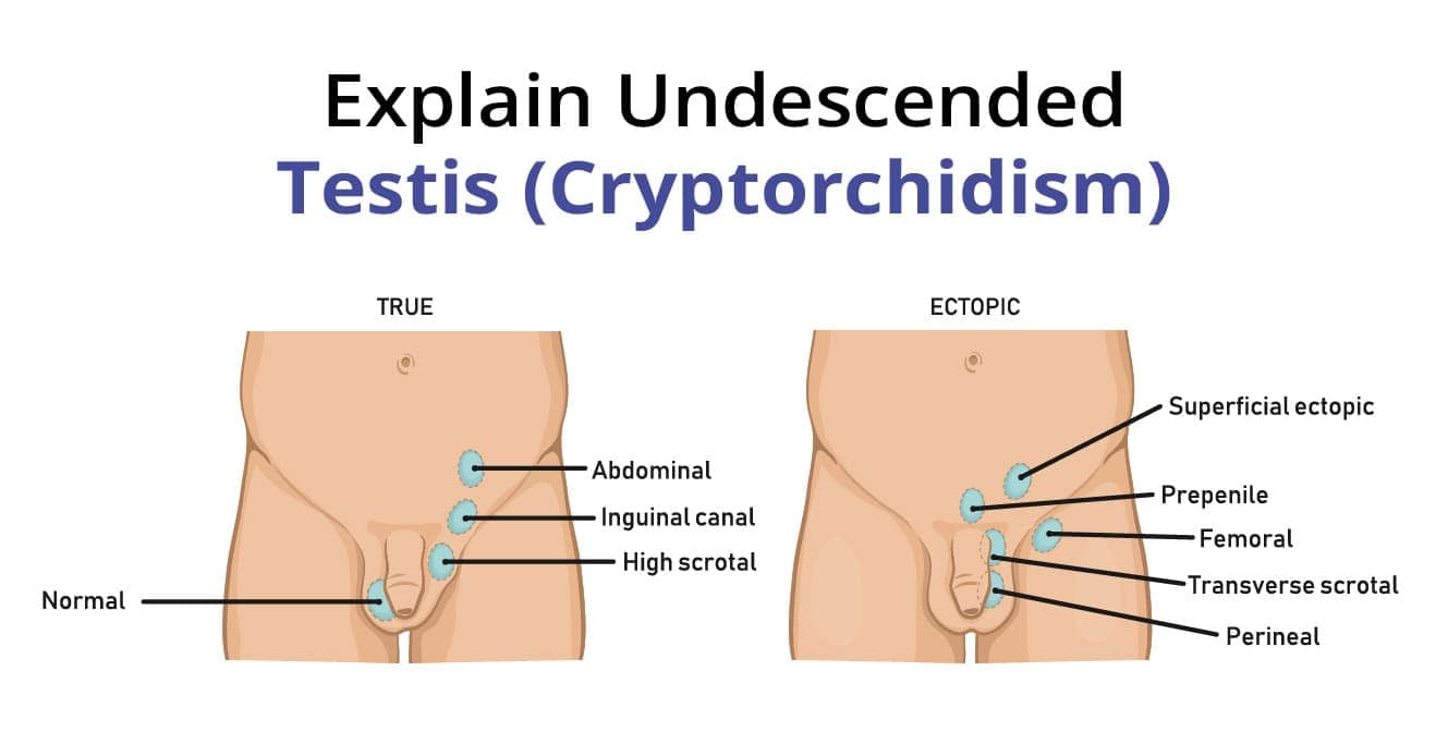 Cryptorchidism (Undescended Testis): Diagnosis, Management, and Prognosis